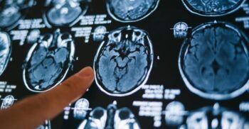 Somnolența la pacienții cu Alzheimer, cauzată de leziuni ale neuronilor responsabili cu starea de veghe