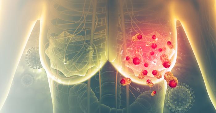 Inteligența artificială prezice mai precis evoluția cancerului de sân