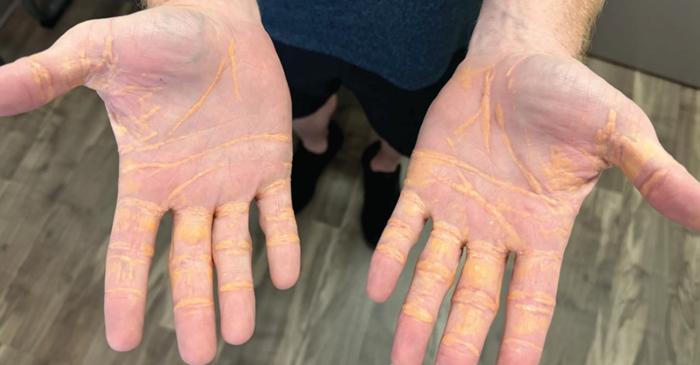 Un bărbat din Florida a dezvoltat noduli galbeni după opt luni de dietă exclusiv cu carne