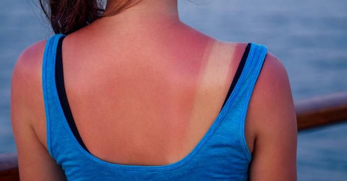 Care sunt cauzele reale ale arsurilor solare?