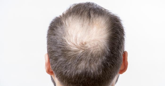 Un nou tratament pentru alopecie stimulează regenerarea părului fără a afecta sistemul hormonal