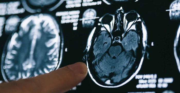 Lipsa de litiu din creier ar putea declanșa boala Alzheimer