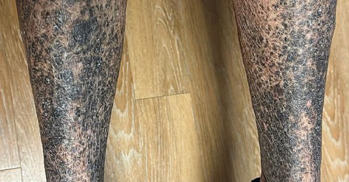 Un antibiotic a colorat în gri-albastru brațele și picioarele unei femei în doar două săptămâni