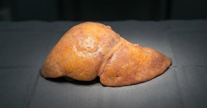 Un francez din cinci are ficatul infiltrat cu grăsimi fără să știe