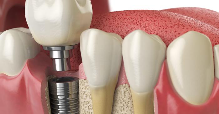 Cum a reușit un implant dentar să transmită senzații creierului?