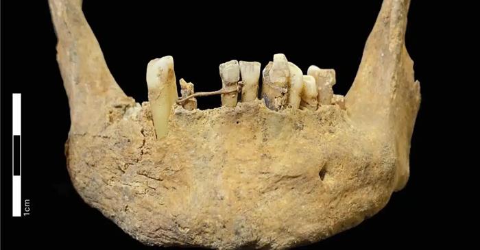 Un craniu medieval din Scoția a dezvăluit un pod dentar din aur masiv