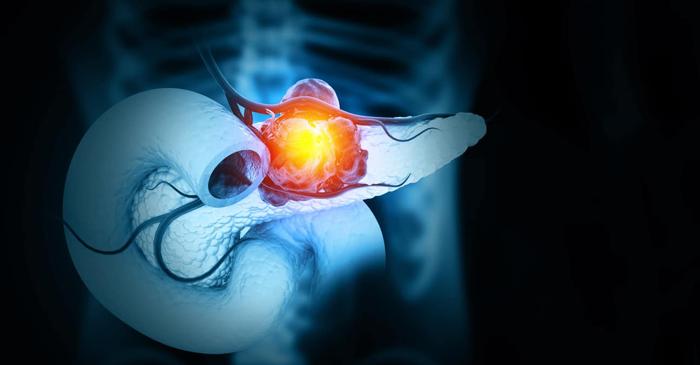 Un sistem de inteligență artificială detectează cancerul pancreatic cu 16 luni înainte de simptome